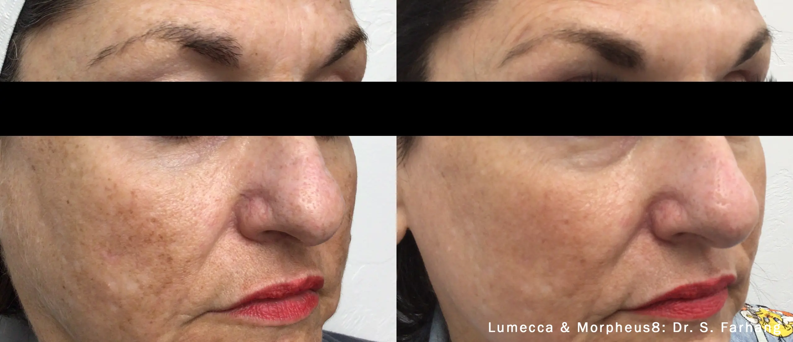 lumeca-before-after-sylmar-med-spa-in-sylmar-CA-two