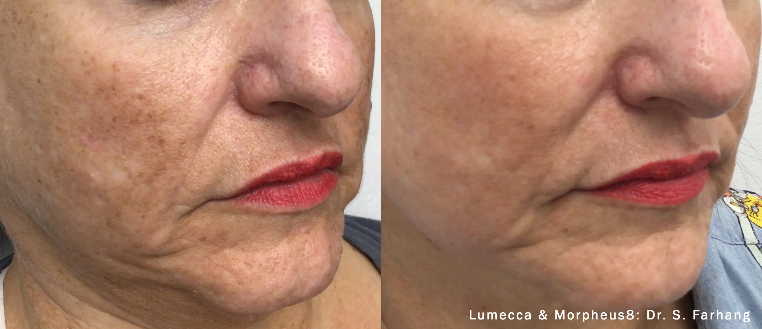 lumeca-before-after-sylmar-med-spa-in-sylmar-CA