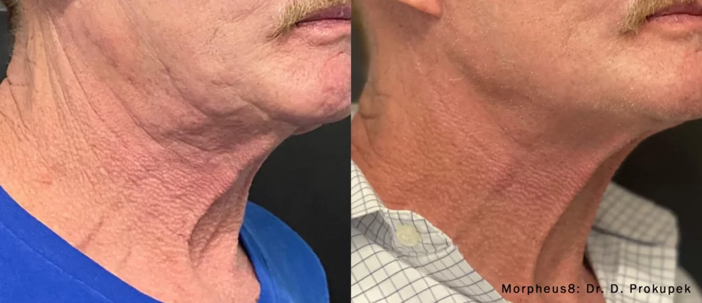 morpheus8 before & after