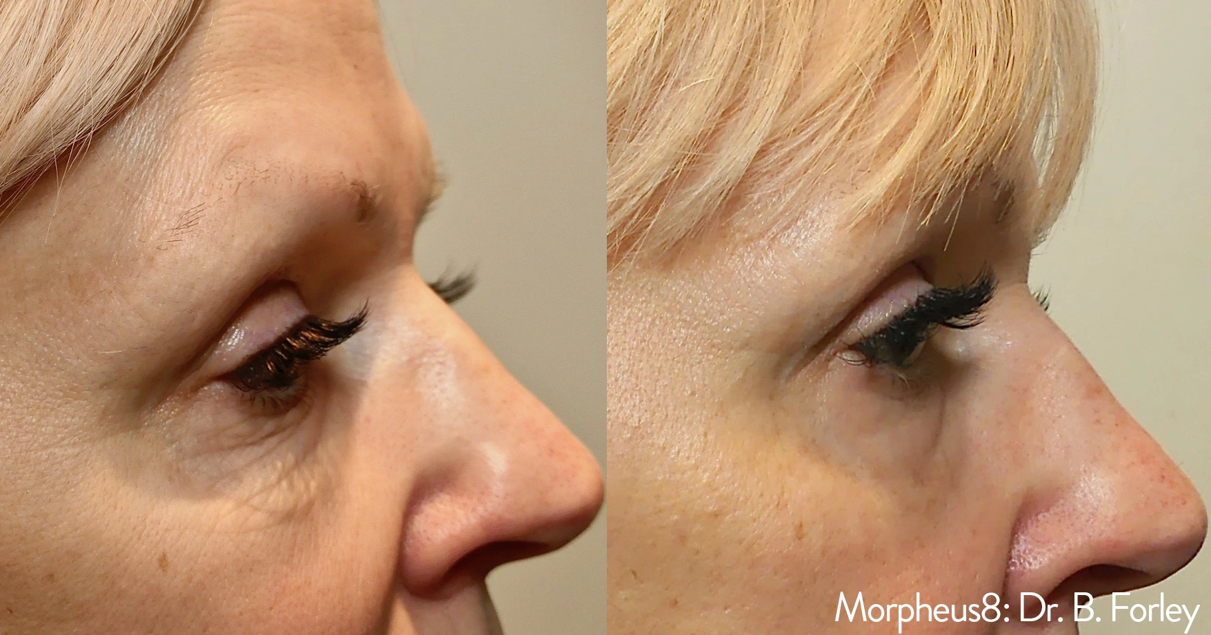 morpheus8-before-after-sylmar-med-spa-in-sylmar-CA-nine