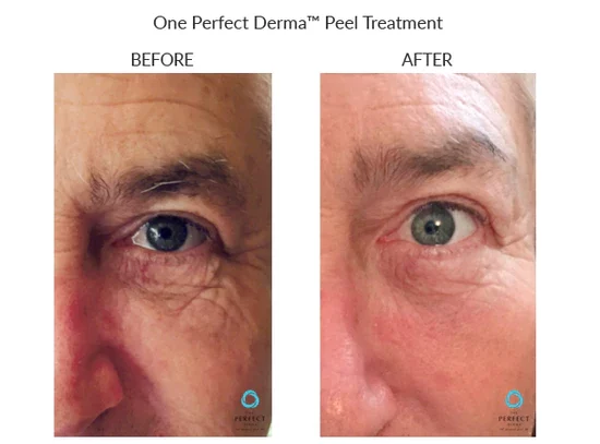 before-after-a-chemical-peels-in-sylmar-ca