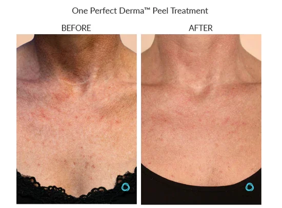 before-after-b-chemical-peels-in-sylmar-ca