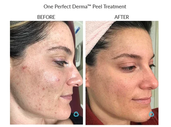 before-after-c-chemical-peels-in-sylmar-ca