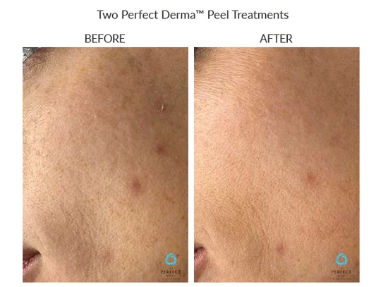 before-after-d-chemical-peels-in-sylmar-ca