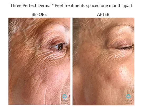 before-after-e-chemical-peels-in-sylmar-ca