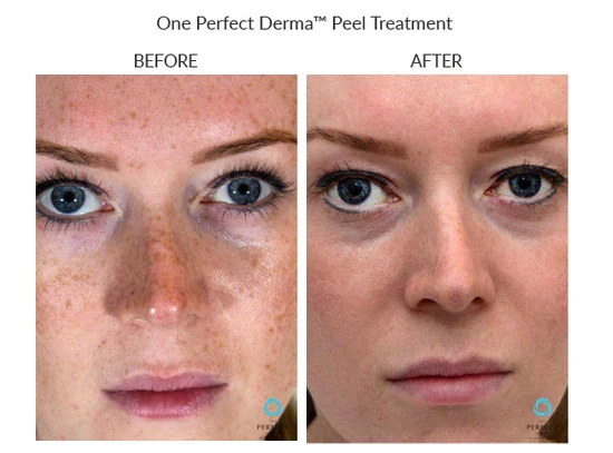 before-after-f-chemical-peels-in-sylmar-ca