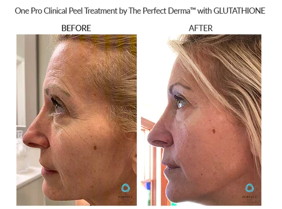 before-after-g-chemical-peels-in-sylmar-ca