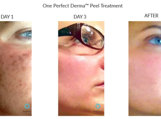 before-after-h-chemical-peels-in-sylmar-ca