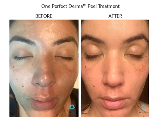 before-after-i-chemical-peels-in-sylmar-ca