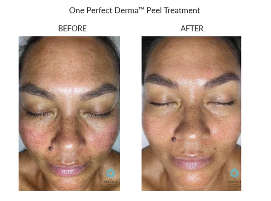 before-after-j-chemical-peels-in-sylmar-ca