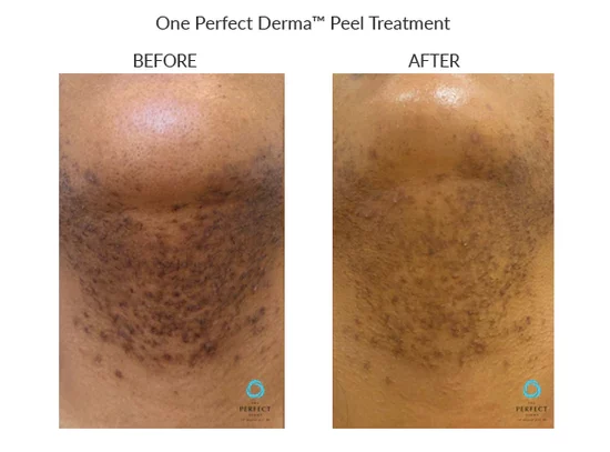 before-after-k-chemical-peels-in-sylmar-ca