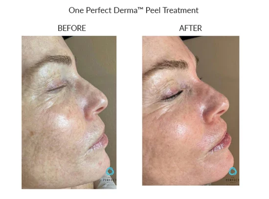 before-after-l-chemical-peels-in-sylmar-ca