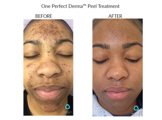 before-after-m-chemical-peels-in-sylmar-ca