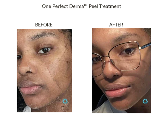 before-after-n-chemical-peels-in-sylmar-ca