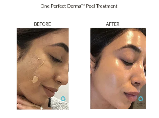 before-after-o-chemical-peels-in-sylmar-ca