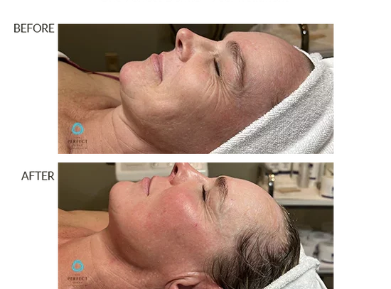 before-after-p-chemical-peels-in-sylmar-ca