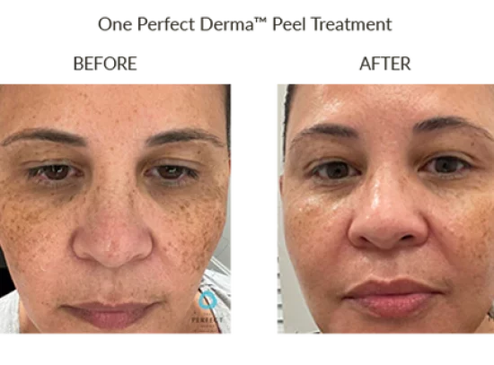 before-after-q-chemical-peels-in-sylmar-ca