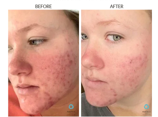 before-after-r-chemical-peels-in-sylmar-ca